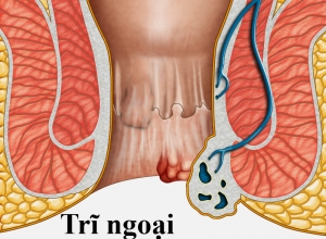 Làm thế nào để phân biệt các cấp độ của bệnh trĩ ngoại? 